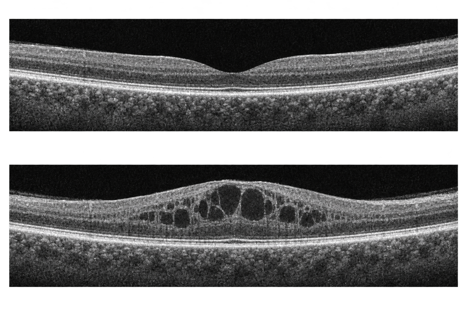 Original OCT-style illustration: a normal macula with a central dip above, and a thickened macula with dark intraretinal fluid spaces below.