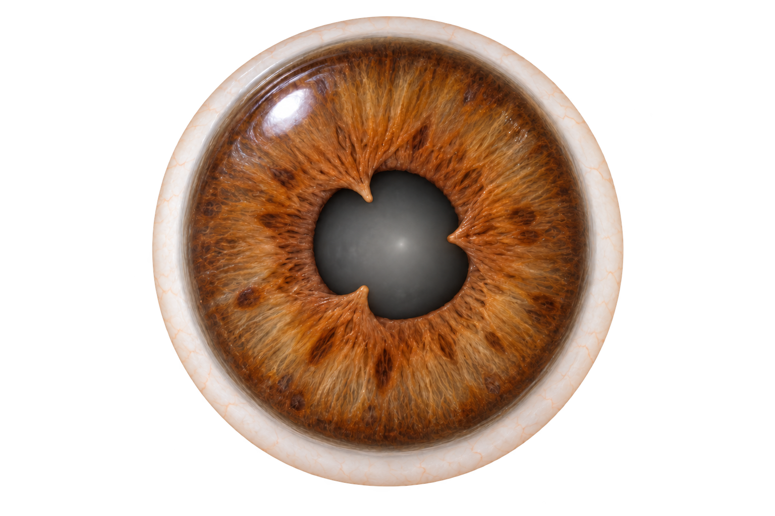 Original front-view illustration of a brown iris with an irregular pupil, illustrating the appearance that posterior synechiae can cause.