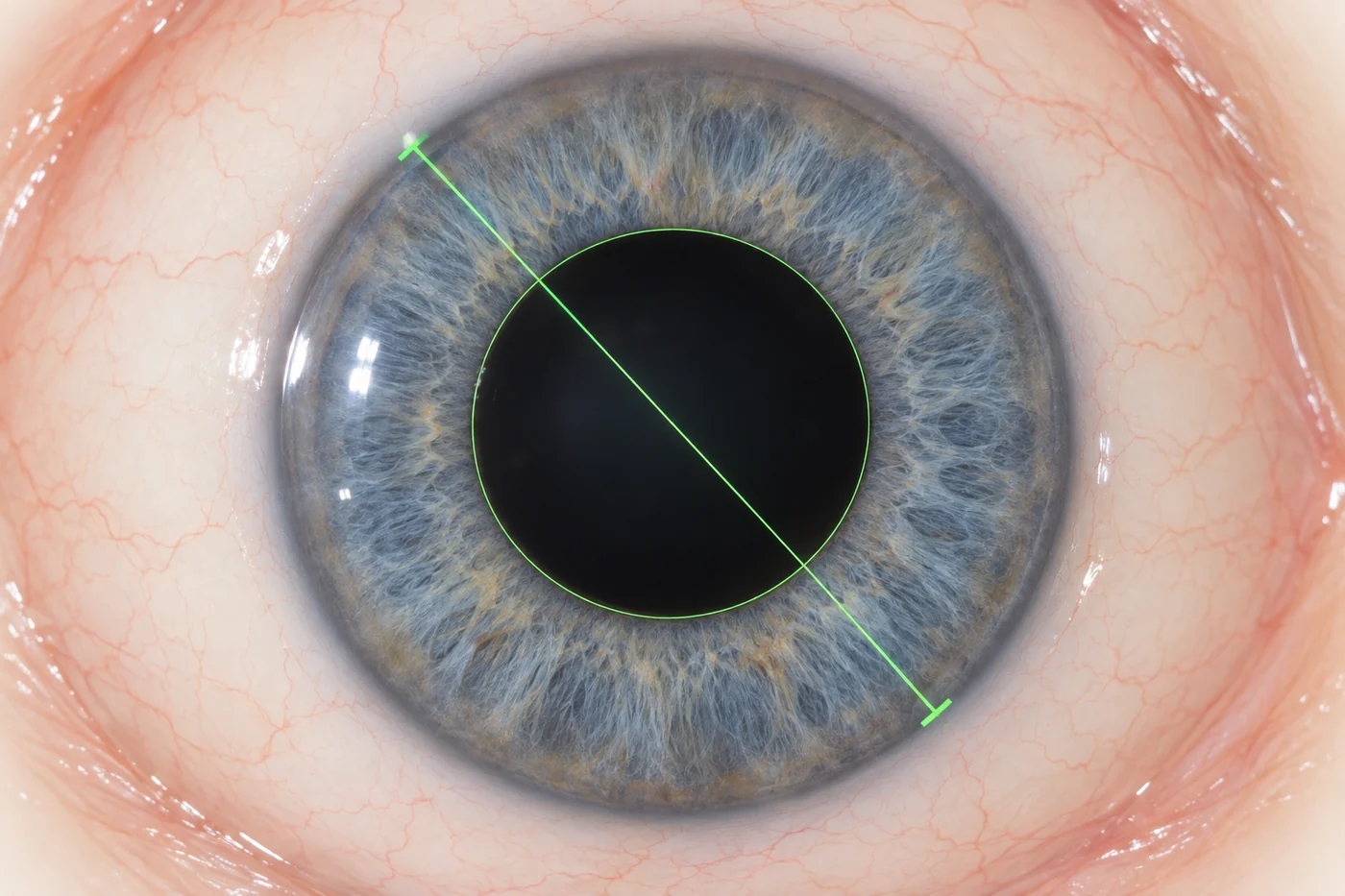 A view down the operating microscope showing a fine green line projected across the pupil with matching marks at the edge of the cornea.