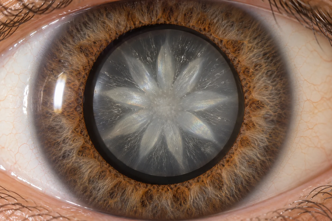 A slit-lamp view of a lens showing a star-shaped opacity radiating from the centre like the petals of a sunflower.