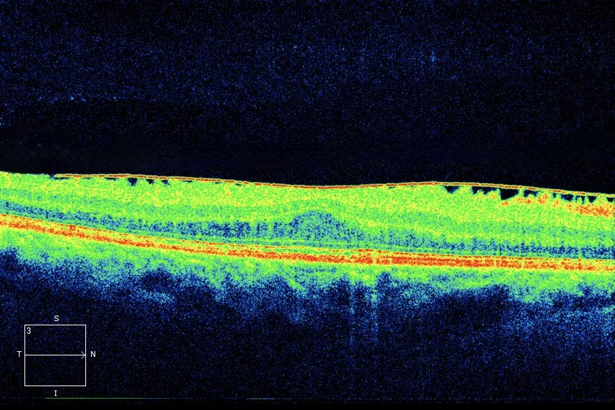 Macular OCT with a bright membrane on the retinal surface and a thickened central retina without its usual foveal dip.