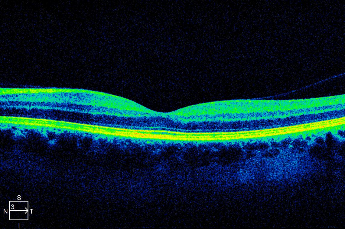 Normal macular OCT cross-section with a central foveal dip and no epiretinal membrane.
