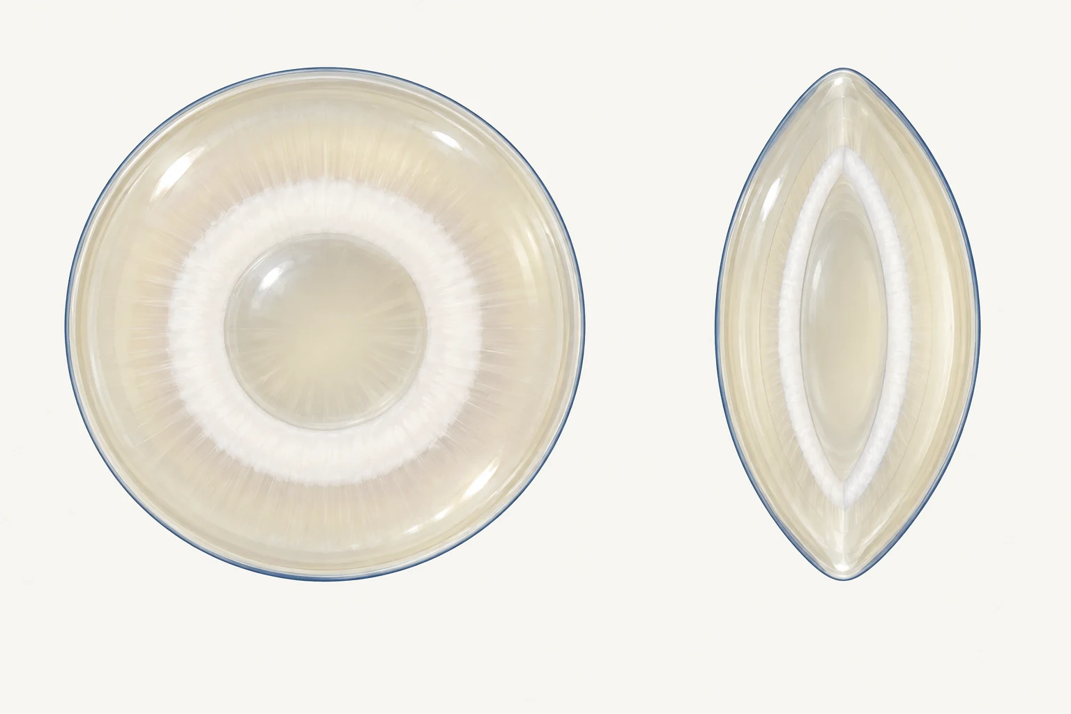 Front view and side optical section of a lamellar cataract, showing a cloudy layer surrounding a clearer central nucleus with a clearer outer cortex.