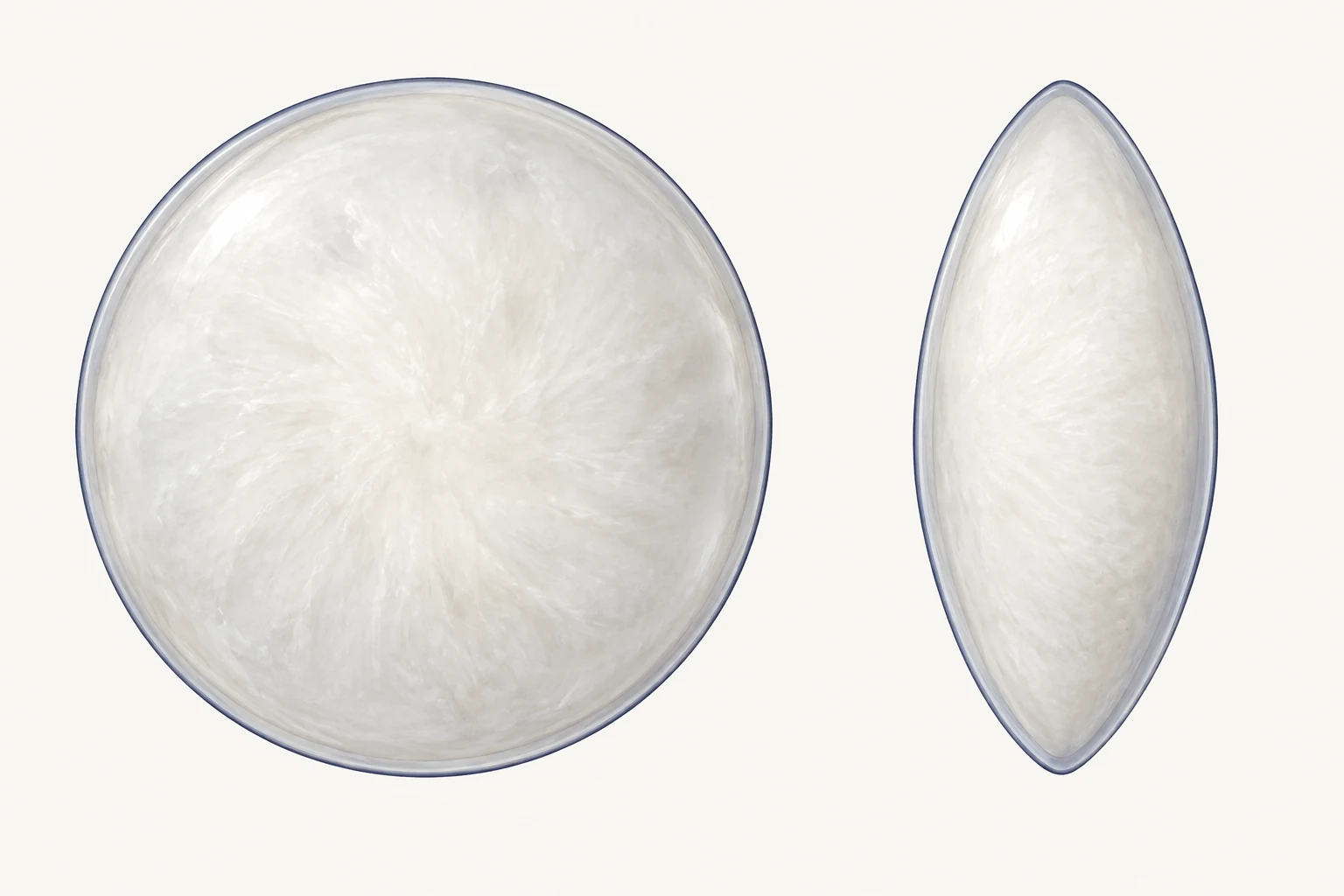 Front view and side optical section showing a mature white cataract with widespread opacity throughout the natural lens.