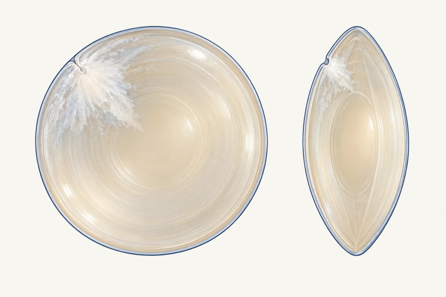 Front view and side optical section showing an example of localised lens clouding beneath a small anterior capsular injury.