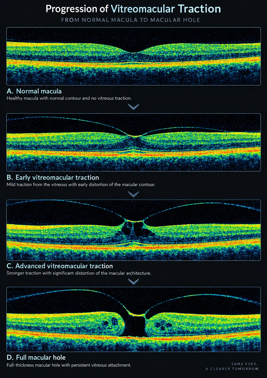 Four labelled panels showing a normal macula, early vitreomacular traction, advanced vitreomacular traction and a full-thickness macular hole.
