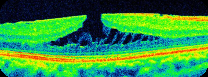 ERM foveoschisis. Surface traction accompanies splitting within the foveal retina. A split within tissue is different from a complete retinal opening.