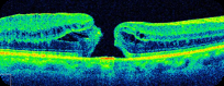 Full-thickness macular hole. A complete opening interrupts the neural retina at the fovea, with elevated edges and adjacent cystic spaces. The reflective RPE band remains beneath the opening.
