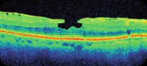 Lamellar macular hole. An irregular foveal cavity has undermined edges and retained outer retinal tissue beneath it. The defect is partial thickness.