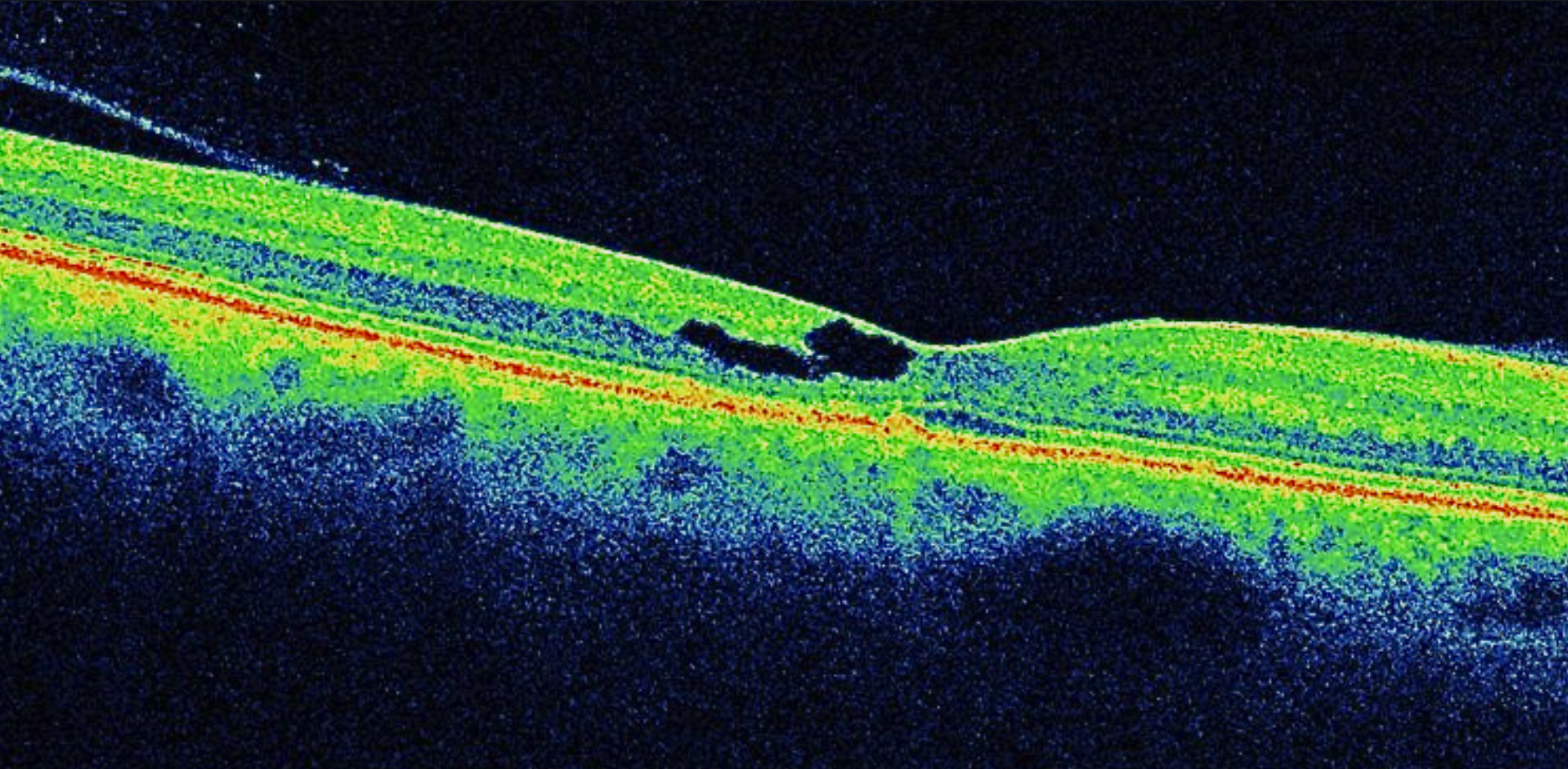 MacTel-associated cavitation. Foveal hyporeflective cavities lie beneath a retained inner retinal roof. There is no complete opening through the retina in this scan; cavitation should not be equated with an FTMH.
