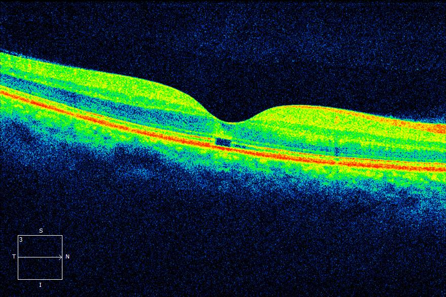 Macular microhole: focal outer-retinal defect. A small focal outer-retinal defect lies beneath retained inner foveal tissue. The scan does not show a complete opening through all neural retinal layers.