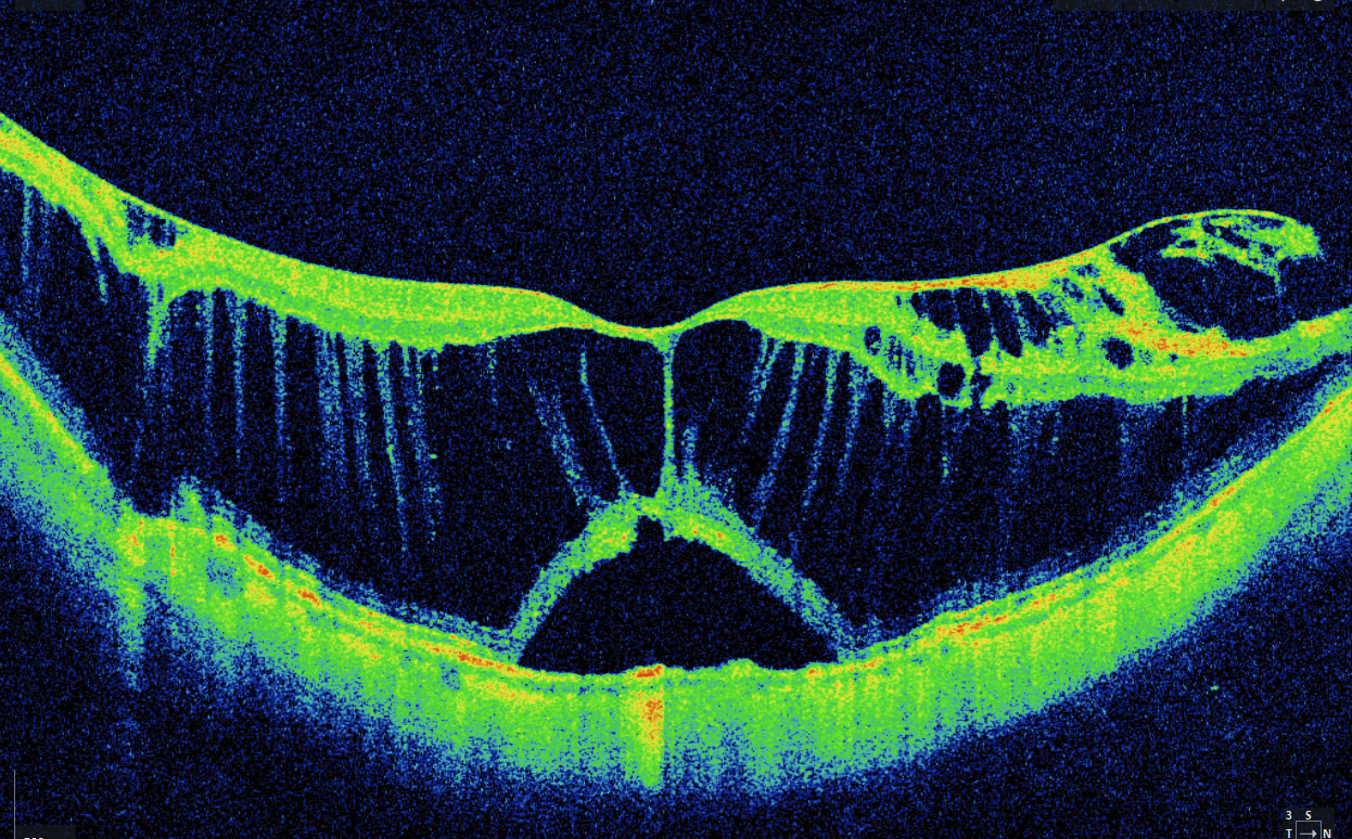 Myopic foveoschisis. Extensive intraretinal splitting contains bridging columns. The central outer retinal tissue is also elevated above the underlying RPE, illustrating associated foveal detachment.