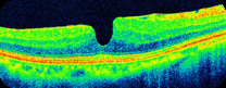 Macular pseudohole. The foveal pit is steep and narrow, with retinal tissue continuing across its floor. This is a contour change rather than a full-thickness defect.