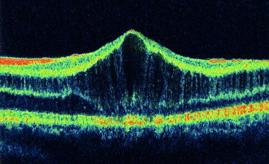 X-linked retinoschisis. A large central schisis cavity separates the retinal layers, with a retained retinal roof and floor and bridging tissue. This is intraretinal splitting rather than a full-thickness macular opening.