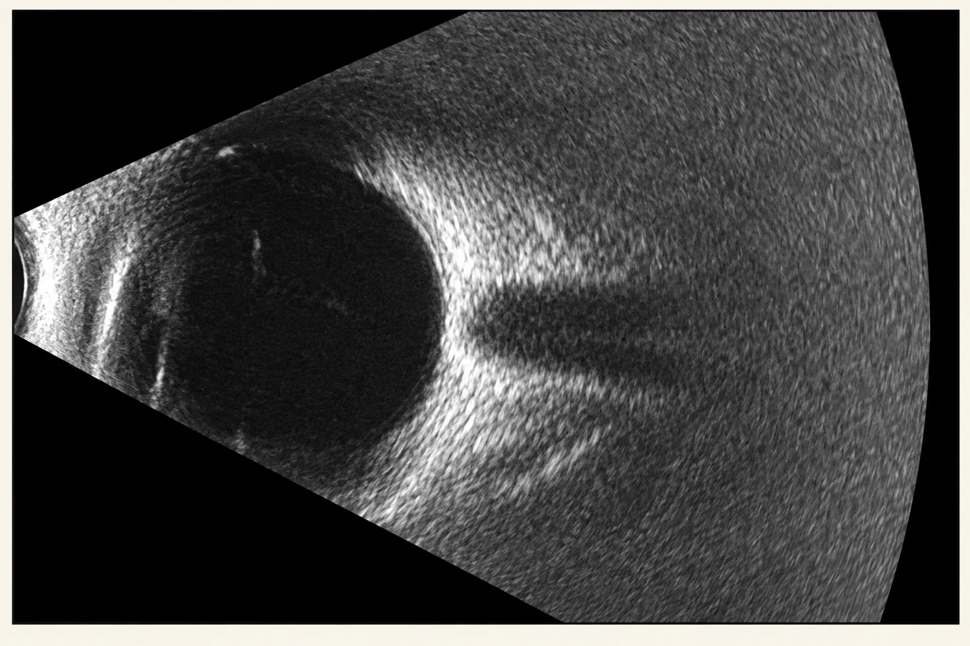 B-scan ultrasound of the eye: a fan-shaped greyscale scan showing the eye wall and optic nerve.
