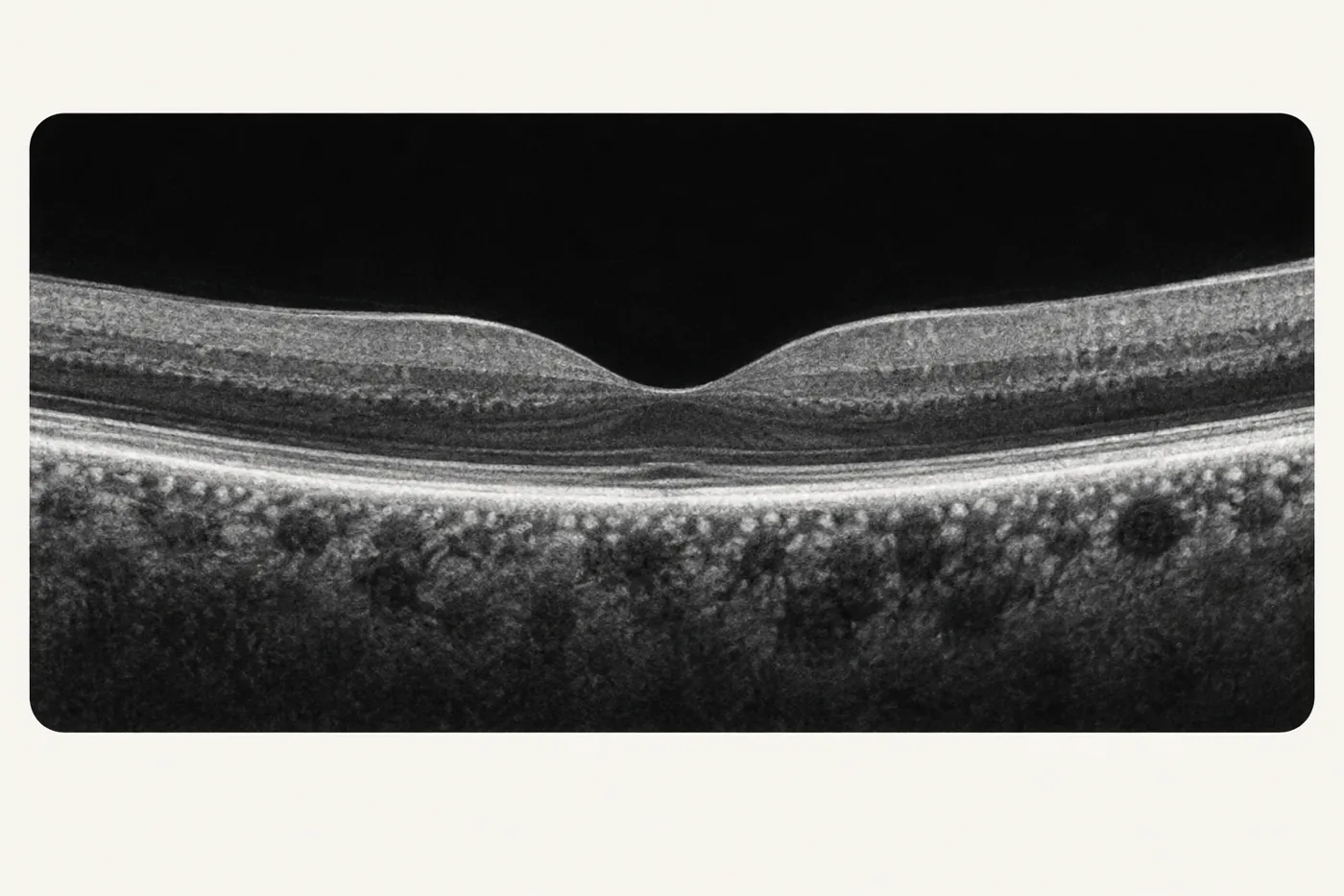 OCT scan: a greyscale cross-section of the macula showing the retinal layers and the central dip of the fovea.