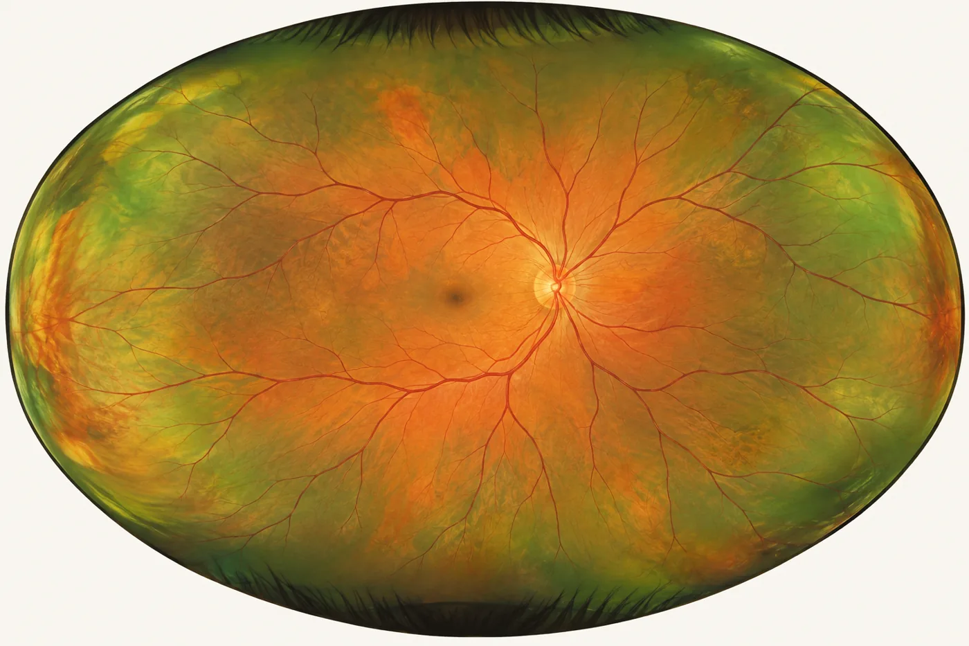 Ultra-widefield retinal image showing almost the whole retina, including the far periphery.