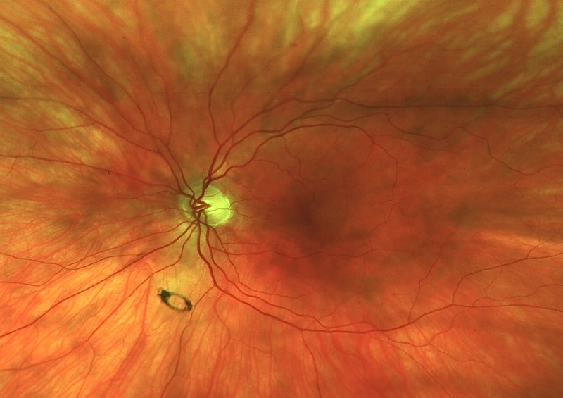 Fundus photograph showing a dark oval Weiss ring below the optic disc.