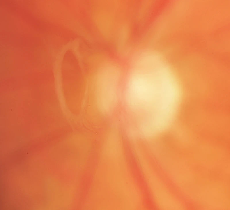 Cropped fundus photograph showing an oval Weiss ring to the left of the optic disc.
