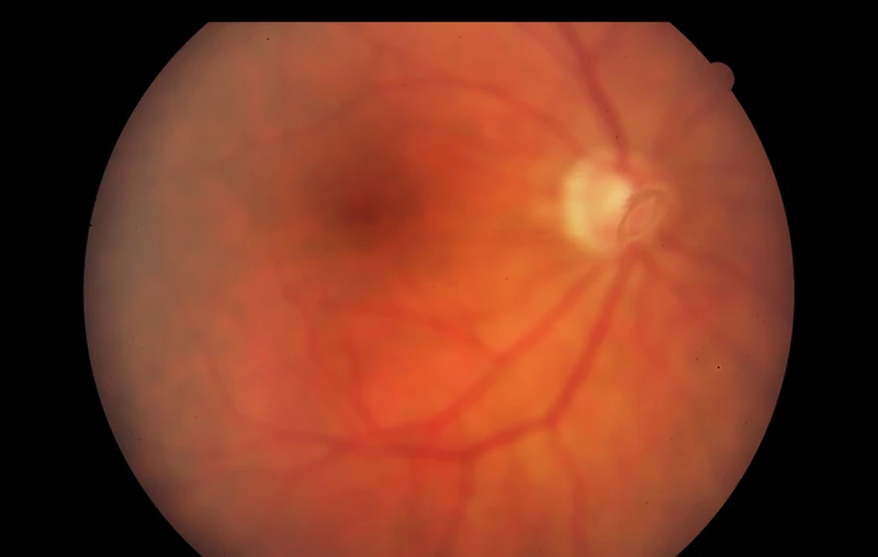 Fundus photograph showing a Weiss ring beside the optic disc.