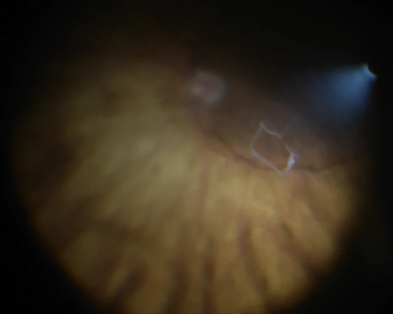 Operating-microscope view showing a Weiss ring during vitrectomy surgery.